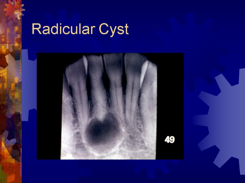 Radicular Cyst